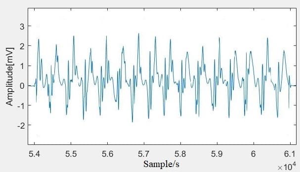 Figure 13 shows the results obtained from the operation of  synchronized average made of 10 consecutive cardiac cycles.  The average signals of ECG and SCG show the continuity of  the annotations of the  seismocardiographic signals.  Comparing this average signal with another standard  annotation scheme proposed by Anh Dinh (2011) also verify  this research result [16]. Comparison of these two signals are  given in figure 14.