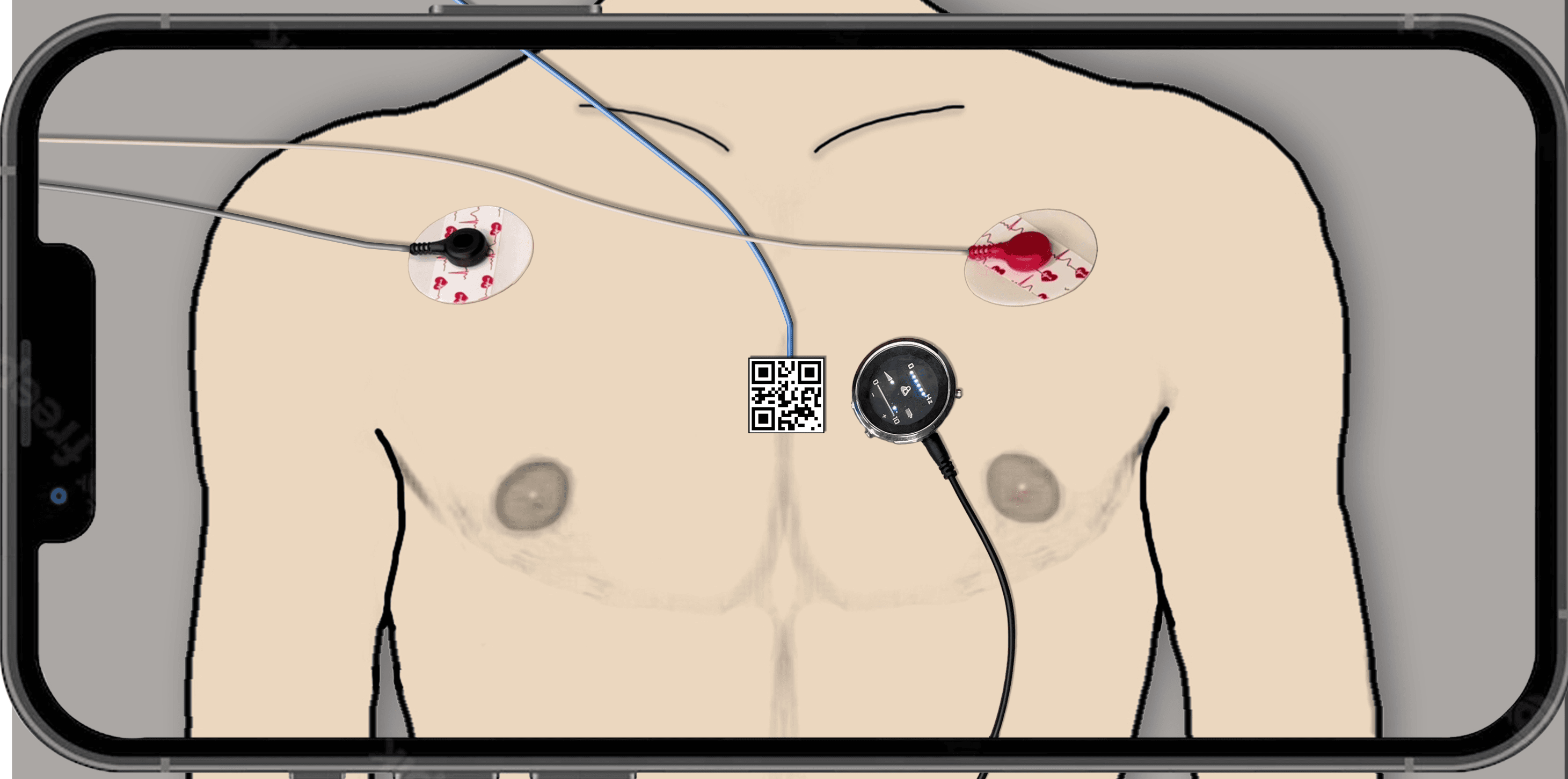 Figure 1. Data acquisition and sensor placement setup. Chest videos were recorded using an ordinary camera phone. Simul- taneously, an accelerometer was used to record SCG signals. A sticker patterned with a QR code was attached to the top face of the accelerometer to facilitate the extraction of SCG signals from the chest videos.