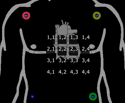 Figure 1. Accelerometer locations and ECG electrode positions.  Accelerometer 3,2 is placed above the Xiphoid Process.  Vibrations are defined in the positive directions of the three  cardinal axes: frontal (left), vertical (superior), and sagittal  (anterior).