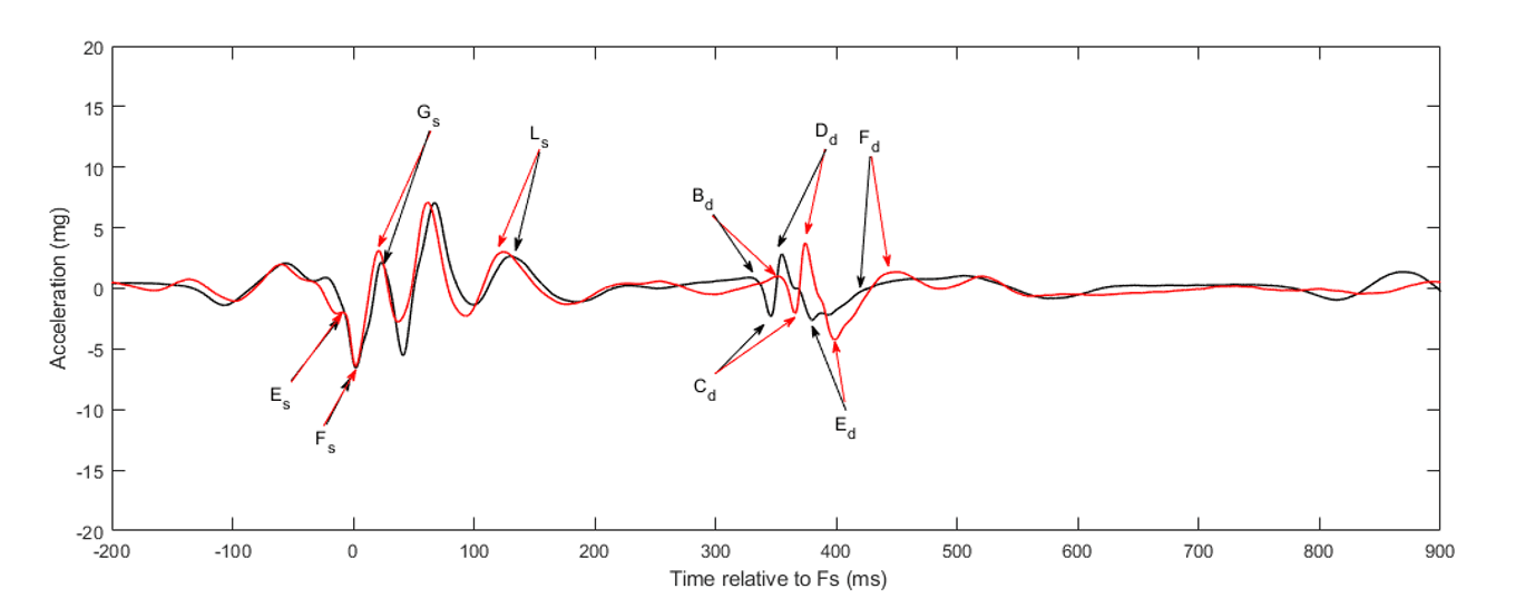 Table 1: Data from seismocardiography before (pre) and after (post) fluid infusion. **P < 0.01 and *P < 0.05. Data  represents median and IQR. Differences are pre-post. g gravity and ms millisecond