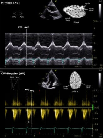 Figure 1. Echocardiographic representation of MVO/MVC and AVO/AVC.