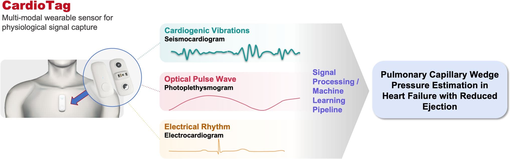 Fig. 1   Physiologic signals from non-invasive sensor for pulmonary  capillary wedge pressure estimation. CardioTag (Cardiosense, Inc.,  Chicago, IL) is a wearable sensor patch capable of capturing seis- mocardiography, photoplethysmography, and electrocardiography