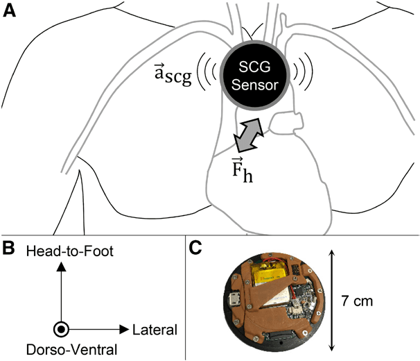 Figure 1. Seismocardiogram (SCG) and ECG sensing  patch.   A, The SCG signal represents the vibrations of the chest wall  in response to the movement of the heart and blood with  each heartbeat. SCG is measured using a miniature, 3-axis  accelerometer, typically positioned on the midsternum. B,  The SCG signal consists of vibrations in 3 axes: head-to-foot,  dorso-ventral, and lateral. C, A custom, small, wearable  patch for measuring SCG and ECG signals was designed.  The patch is placed on the chest using 3 gel adhesive  electrodes and stores data locally on a micro secure digital  card. The low power design allows for >50 h of continuous  recording and use without recharging the battery.