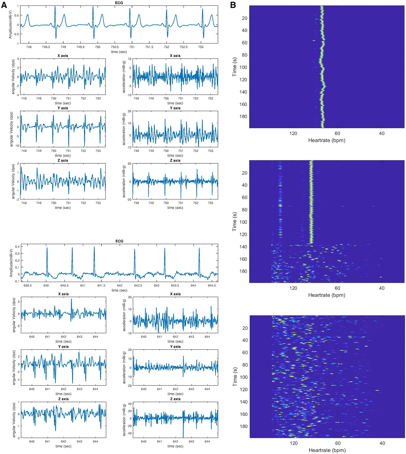 Figure. Visual presentation of mechanocardiography data.   A, Electrocardiographic, accelerometer, and gyroscope signals are presented in sinus rhythm (top) and atrial fibrillation (bot- tom). The corresponding heartbeats can be located in both the mechanical and the electrocardiographic signals during sinus  rhythm and atrial fibrillation. Because the different axes of the accelerometer and gyroscope signals appear to vary in quality,  our algorithm takes advantage of combining the information from various axes to provide a reliable estimate of the heart  rhythm. B, Mechanocardiography signal periodicity is represented visually in sinus rhythm (top), sinus rhythm converting to  atrial fibrillation (middle), and atrial fibrillation (bottom). The vertical axis represents time in seconds, and the horizontal axis  represents the instant period of the signal converted into beats per minute to denote heart rate. A continuous signal shape is  observed during a regular heart rhythm such as sinus rhythm (top), whereas a scattered pattern is observed during an irregular  rhythm such as atrial fibrillation (bottom). Middle, Sinus rhythm abruptly converts to atrial fibrillation at ≈140 seconds.