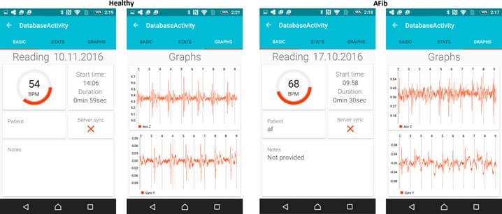 Fig. 6. Two screenshots from the AFib detection application running in Sony Xperia Z3. On the left a normal subject, and on the right an AFib subject. The data is shown only in (ACCZ and GYROY) axes. Before starting the measurement, the information of the user is ﬁlled in, and after the measurement the application informs the user whether he/she has AFib. The patient in this case suffered from chronic AFib, where the heart rate is made lower by medication and therefore the heart rate of the AFib patient is relatively low.