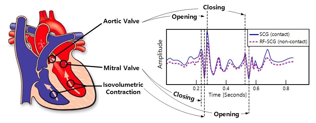 Figure 1—Contactless SCG Recording. The plot to the right shows SCG recordings of a single heartbeat obtained from an accelerometer strapped to the apex of the heart (in blue) and from RF-SCG without any body contact (in purple). RF-SCG can also precisely time five micro-cardiac movements: opening and closing of the aortic valve, opening and closing of the mitral valve, and isovolumetric contraction (of the ventricles).