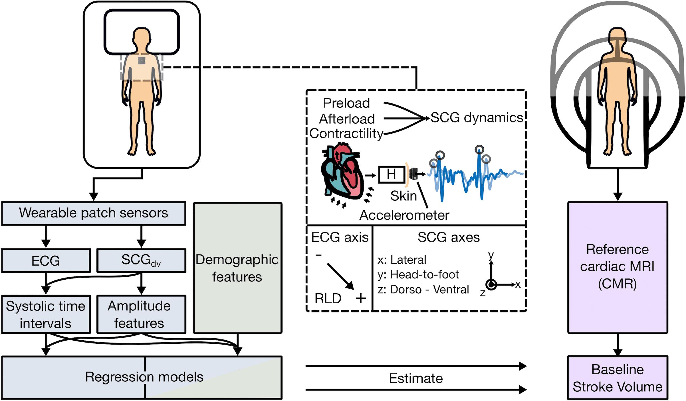 Figure 1.  Concept overview. Study design showing wearable biosensor placement when supine and asynchronous reference cardiovascular magnetic resonance  imaging (CMR) measurement. Seismocardiogram (SCG) mechanistic overview detailing modulation due to cardiac physiology,  acquisition with an accelerometer, and sensing axes for ECG (negative, positive, and right-­leg-­drive [RLD] electrodes), and triaxial  SCG signals. Analysis pipeline, from sensor input to model estimation of stroke volume, for wearable (blue), demographic (green), and  CMR (purple) data. H indicates the transfer function between the input internal sources of cardiomechanical vibration and the output  SCG waveform measured on the surface of the torso; MRI, magnetic resonance imaging; and SCGdv, dorso-­ventral SCG.