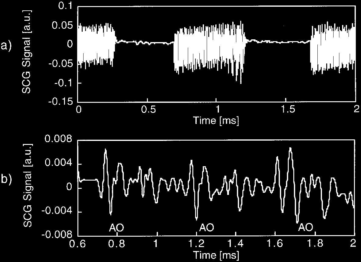 Figure 3. SCG traces recorded in a normal volunteer while the magnetic ®eld gradients are being pulsed for acquisition of cine MRI images. A low pass Butterworth ®lter with a cut-o frequency of 30 Hz was applied to the trace shown in part (a), and the result is shown in (b). The amplitudes at aortic valve opening labeled with AO in (b) are clearly recognizable on the ®ltered waveforms.