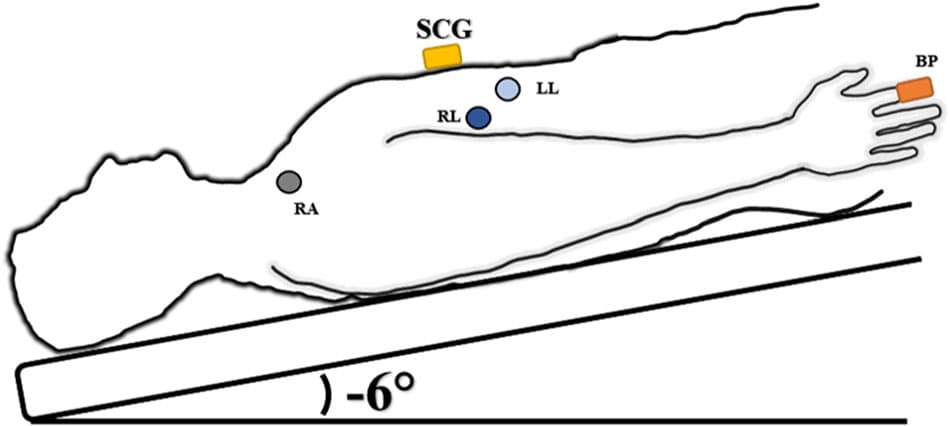 Fig. 1 HDT schematic of sensor placement. SCG (yellow rectangle) placed on the xiphoid process. Blood pressure measured at the finger (orange rectangle). ECG Lead II shown RA lead (gray circle) on right clavicle, RL lead (dark blue circle) on lower right rib cage and LL (light blue circle) on lower left rib cage.