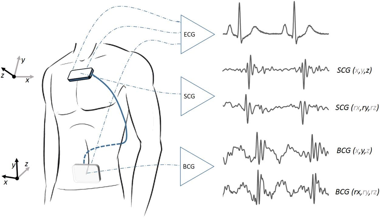 Figure 2. Kino-cardiograph device measuring 2-lead ECG, 6-DOF seismocardiography (SCG) and 6-DOF ballistocardiography (BCG). The standard axis system is used for BCG and SCG: BCG x, y, and z are respectively left-to-right, caudocranial, and ventrodorsal axes; SGC x, y, and z are respectively right-to-left, caudocranial, and dorsoventral axes.