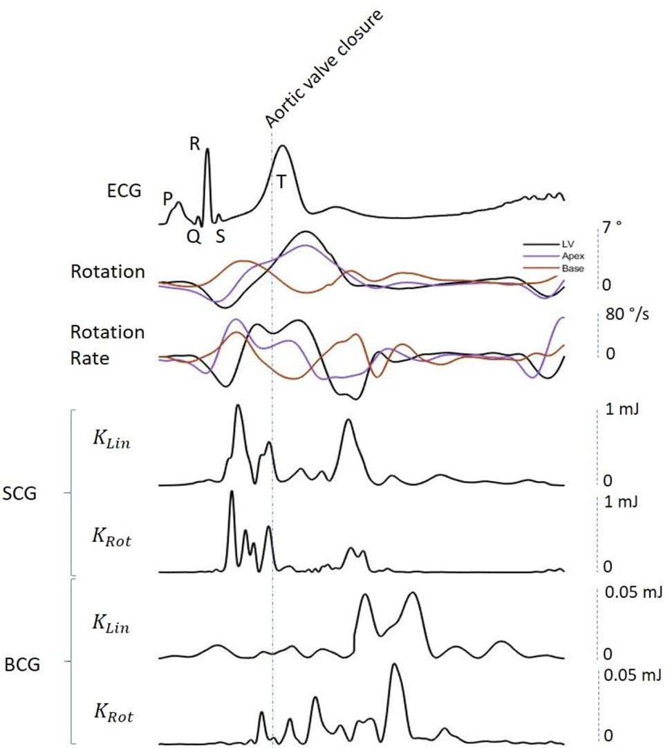 Figure 1. Synchronization of SCG and BCG signals with LV twist. From top to bottom: (a) ECG with the P-Q- R-S-T waves labeled; (b) LV twist, apical and basal rotations; (c) angular rates of LV twist, apical and basal twist rotations; (d) KLin SCG; (e) KRot SCG; (e) KLin BCG; (f) KRot BCG. The first of the two main peaks of KLin SCG (d) and KRot SCG (e) occurs before the aortic valve closure (AVC), during the ejection phase of cardiac cycle and concomitantly with the acceleration of LV twist; the second one occurs after the AVC, synchronously with the deceleration phase of LV twist. With regards to the BCG, waves of KLin and KRot occur almost exclusively after the AVC, during the diastolic phase of cardiac cycle. The Aortic Valve Closure (AVC) is labeled on the figure. KLin kinetic energy in the linear dimension, KRot kinetic energy in the rotational dimension, SCG seismocardiography, BCG ballistocardiography, ECG electrocardiogram, LV left ventricle.