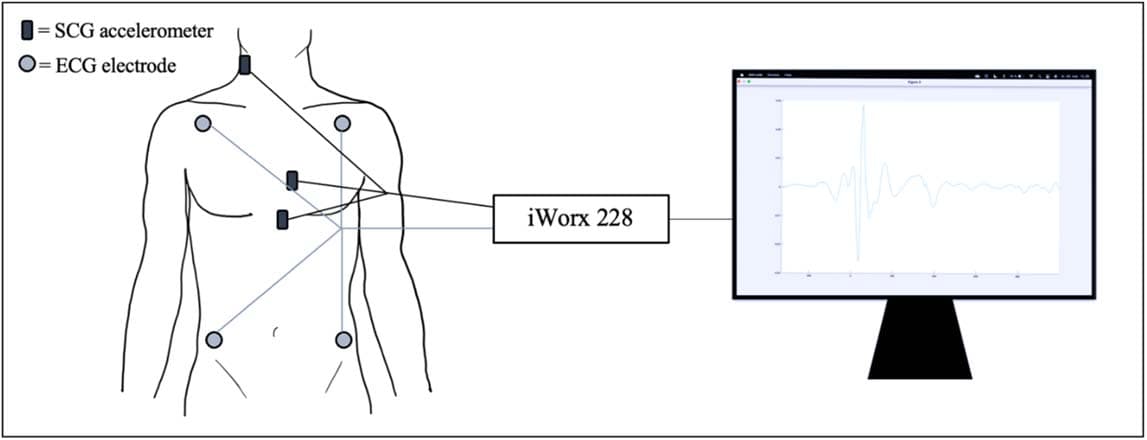 Figure 2. Illustration of the experimental setup including the placement of the SCG accelerometers and the ECG electrodes.