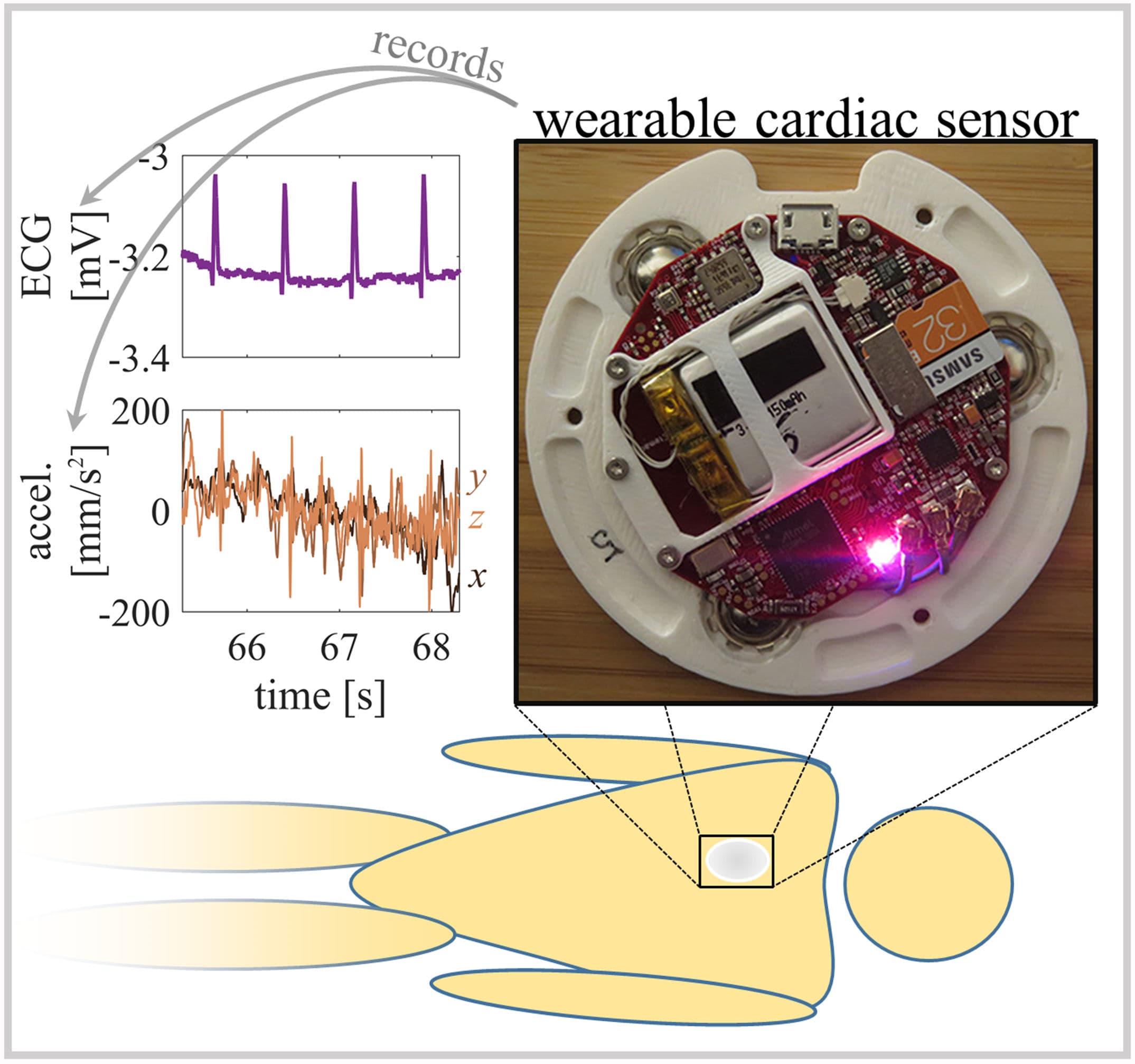 Figure 1. A custom wearable cardiac monitoring device recording ECG and chest accelerations recorded the supine SCG at the sternum.