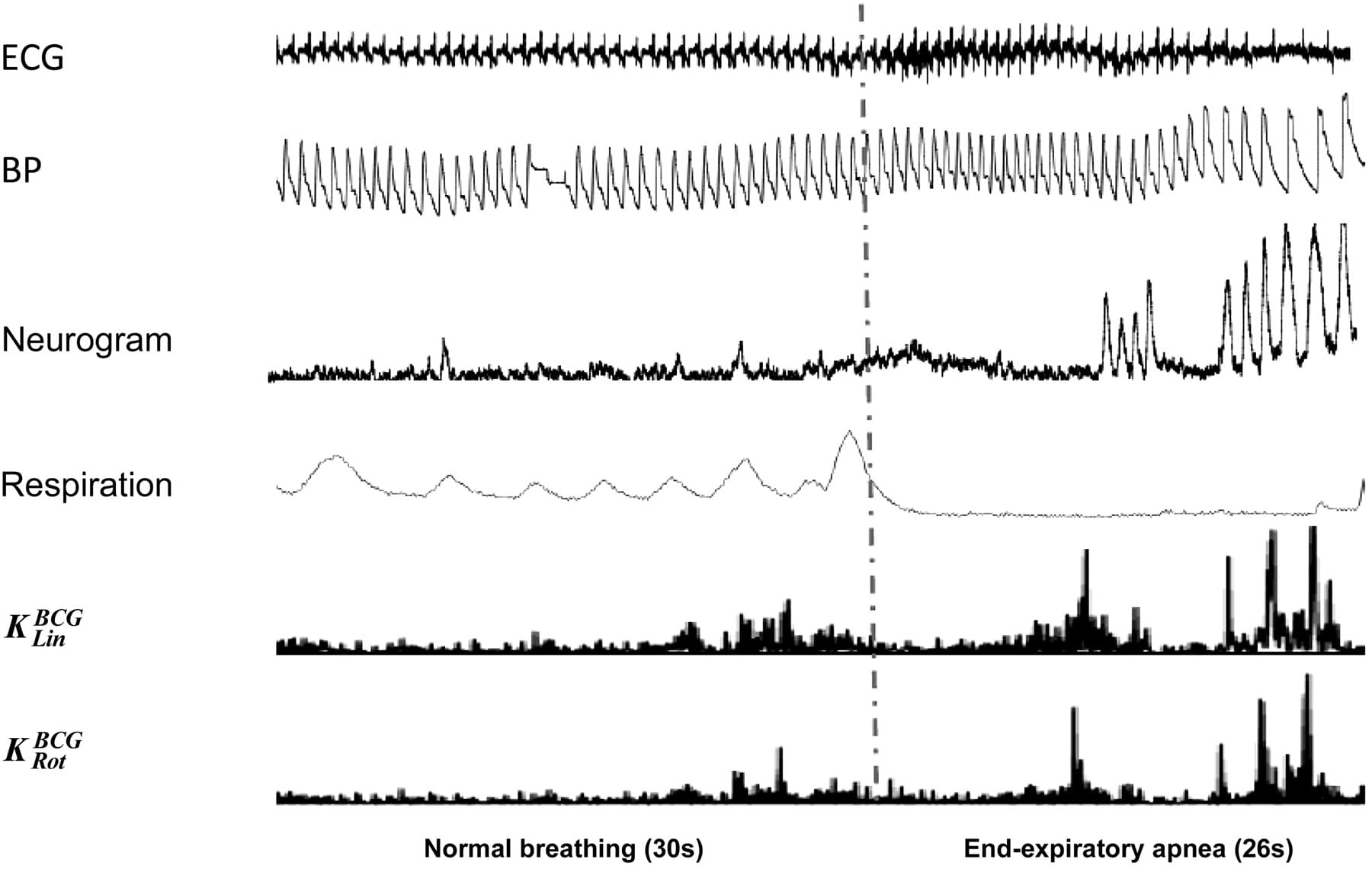 Fig. 2. Muscular sympathetic nerve activity (MSNA) variations along with linear kinetic energy (KLin) and rotational kinetic energy (KRot) of ballistocardiography (BCG) during baseline and maximal end-expiratory voluntary apnea. Normal respiration (30 s long) and maximal voluntary end-expiratory apnea (26 s long) are sep- arated by the vertical dotted/dashed gray line. From top to bottom: ECG, blood pressure (BP), neurogram, respiration, KLin of BCG, and KRot of BCG. At the begin- ning of the apnea, there is a suppression of the sympathetic nerve activity without discernable bursts along with mild cardiac kinetic energy recorded with the BCG in both the linear and the rotational dimension. Heart rate (HR) accelerates compared with normal respiration, and systolic BP slightly falls. Toward the end of the apnea, a marked rise in the sympathetic nerve activity is observed, characterized by an increase in BF and total MSNA (tMSNA), and this is accompanied by a marked increase in linear and rotational kinetic energy. HR slows and systolic BP rises compared with the beginning of the apnea. BF, burst frequency (burst/min).