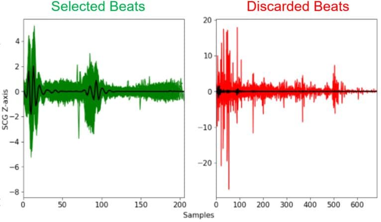 Figure 2: Overlaid selected and discarded cardiac cycles from a subject diagnosed with AS. The plotted Z-axis SCG