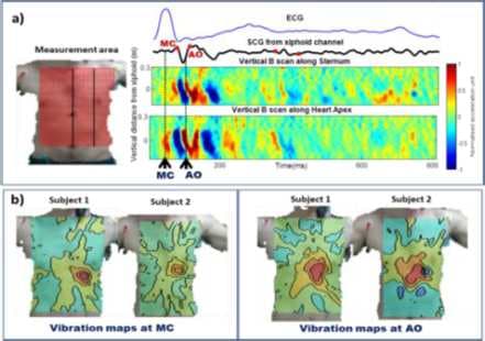 Figure 1.Visual Seismocardiogram (vSCG). a) Time variation along vertical scans b) Spatial distribution of chest surface vibrations at fiducial events- Mitral valve closing (MC) and Aortic valve opening (AO).