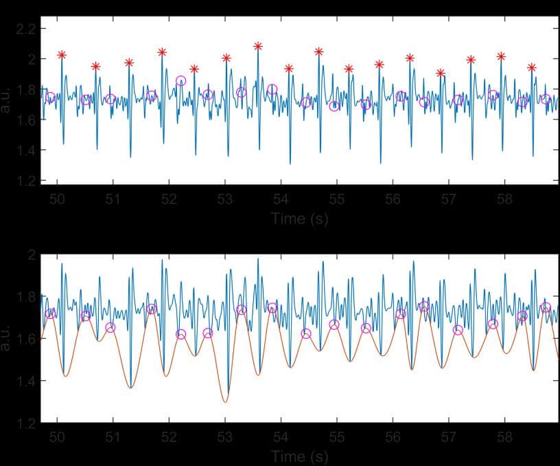 Figure 7 displays results from Slice and Detect. The top plot shows the original signal with its detected peaks (*) and starting points of the cardiac cycle (o), whereas the bottom plot displays the Approximation signal and its lower envelope.