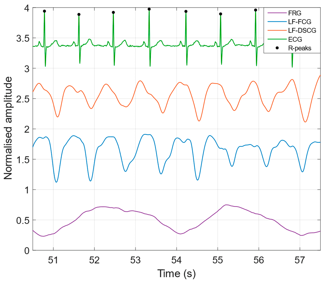 Figure 3. FRG, LF-FCG, LF-DSCG and ECG signals acquired during quiet breathing (subject #2).