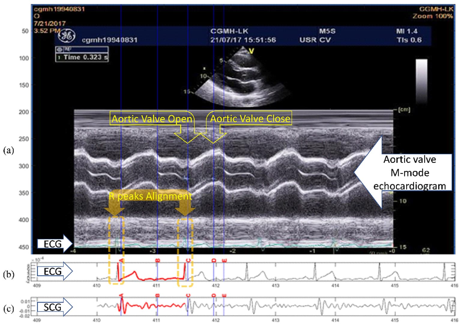 Figure 1. Example of the quasi-synchronous alignment for an echocardiogram image and an SCG measurement: (a) M-mode echocardiogram image of the aortic valve (with an ECG signal at the bottom of the image); (b) ECG signal simultaneously measured with SCG signal; (c) SCG signal.